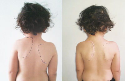 КУРАКНИНГ ТУҒМА ҚИЙШИҚЛИГИ